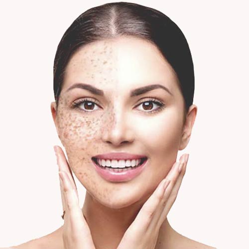Dark Spot & Sun Damage Treatment