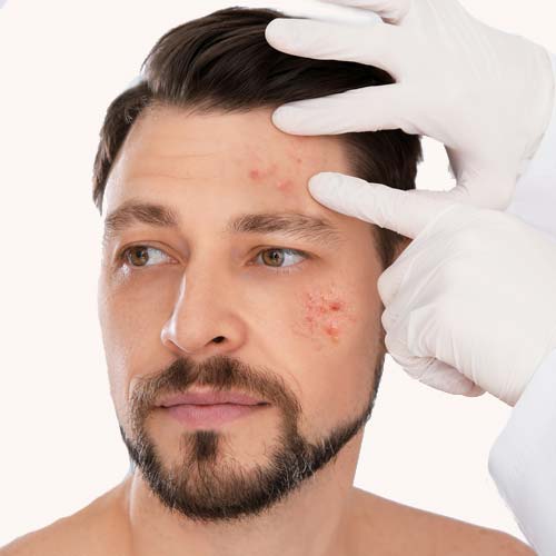 Acne Treatment Extractions