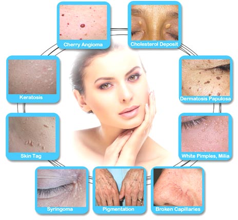 skin tag removal worcester
