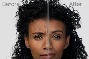 worcester ma best botox