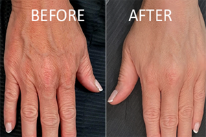 hand fillers worcester ma