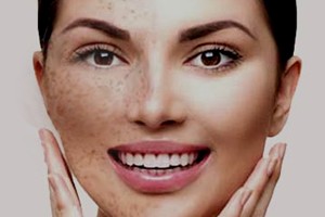 sun damage treatment